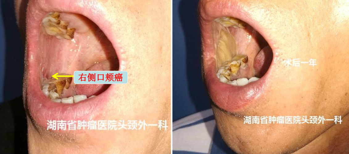 口腔癌术后化疗几次 湖州市井欢马：关于患者的知识普及