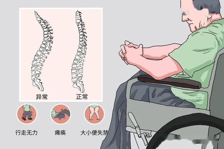 为什么会发生脊柱结核的原因 河北冉蕊黛：关于脊髓的科学普及