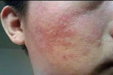 颜面部复发性皮炎 鸡西市终珊茗：关于皮炎的日常科普