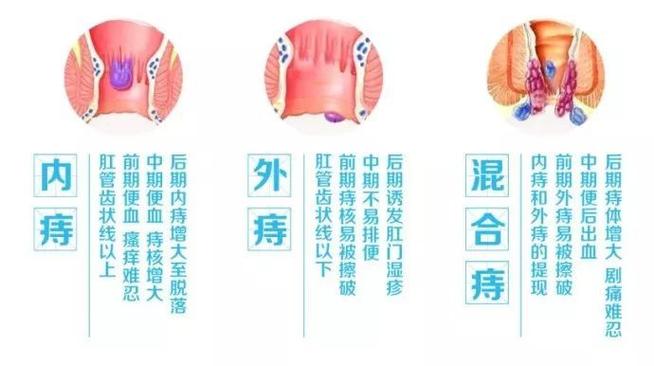 外痔有几种类型怎么区分 2015辽阳市苗欢上日常科普