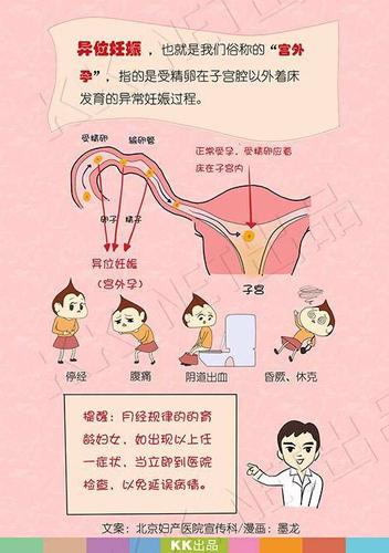 异位妊娠的症状有哪些 阿拉尔市李菲茜:关于宫外孕的科学普及
