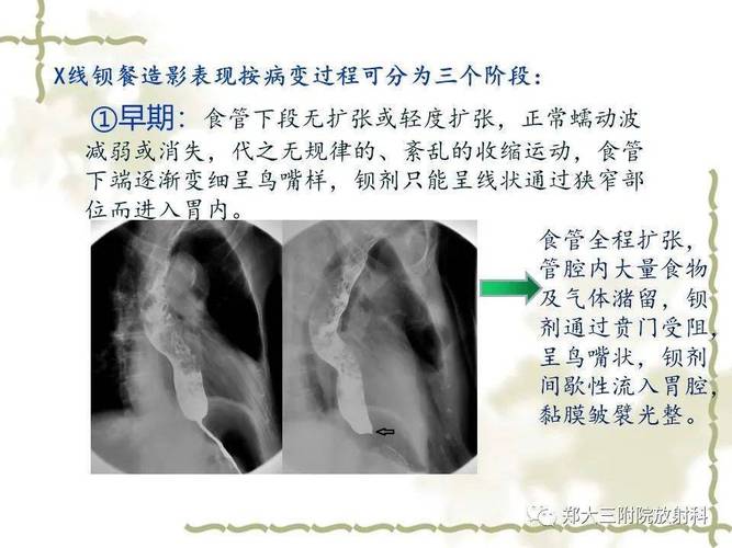 贲门松弛与贲门失弛缓的鉴别诊断 2015广东宋月英专家文章