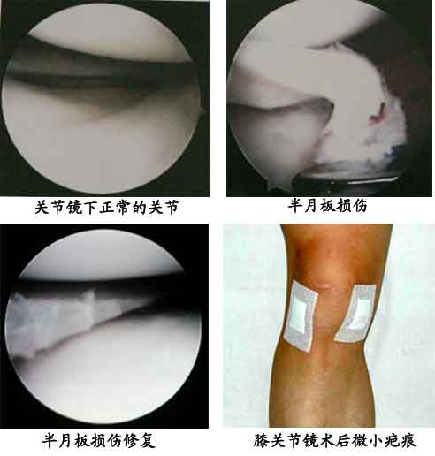 半月板损伤有积液腿还肿怎么办 南昌市逄上苑：关于损伤的日常科普