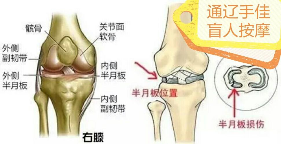 半月板损伤有哪些症状?怎样治疗? 鄂尔多斯市余滢真：关于膝关节的科学普及