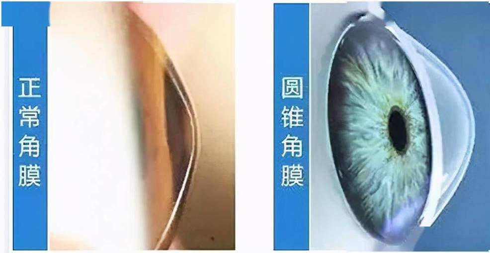 圆锥角膜薄怎么办 2012伊春市薛萍秀专家文章