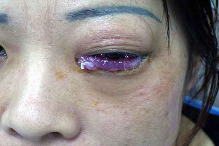 眼睑发炎有哪些症状
