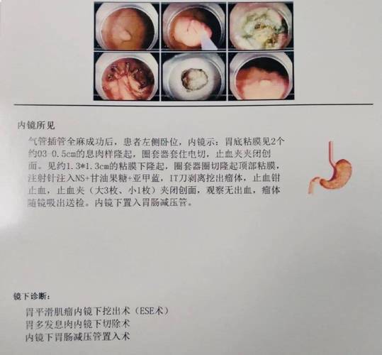 胃窦粘膜慢性炎伴肠化是什么意思 阿拉尔市鲁静冰：关于粘膜的精选文章