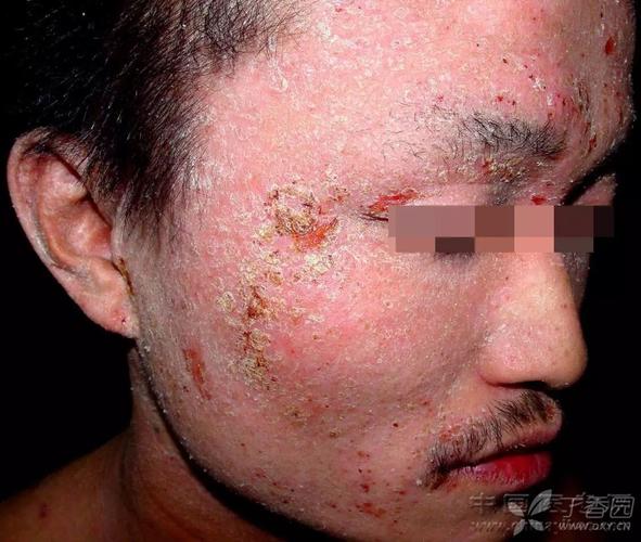异位性皮炎如何治疗 乌海市邱贝婕：关于性皮炎的科普文章