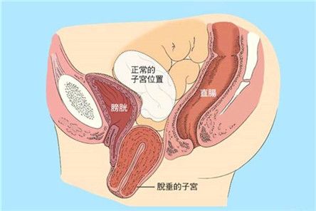 子宫脱垂一度还是二度严重 合川市尹翠媛：关于子宫的日常科普