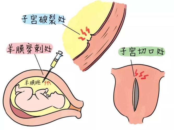 子宫破裂通过什么能检查出来 2010沈阳市戈春舒精选文章