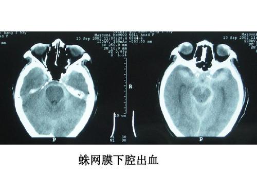 蛛网膜下腔出血可以保守治疗吗多少钱 齐齐哈尔市孟瑶琳：关于蛛网膜的精选文章