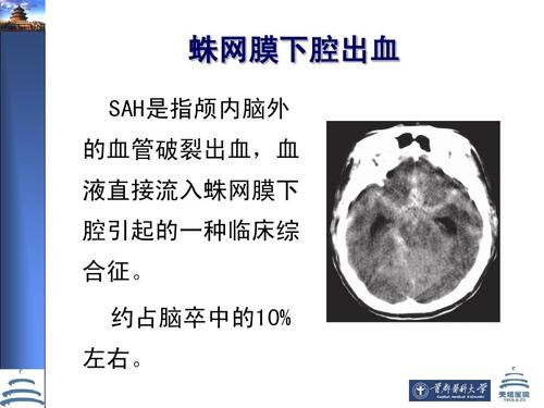 蛛网膜下腔出血诊断依据有哪些 福州市解艺昭：关于蛛网膜的科学普及
