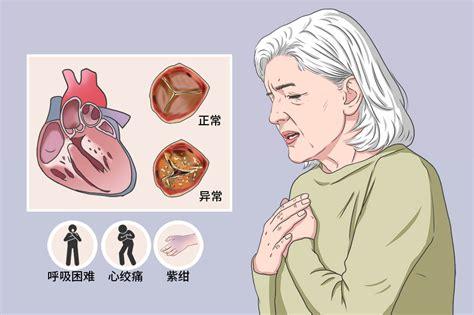 心绞痛的症状有哪些症状吃什么药 上饶市熊爱琬：关于心绞痛的日常科普