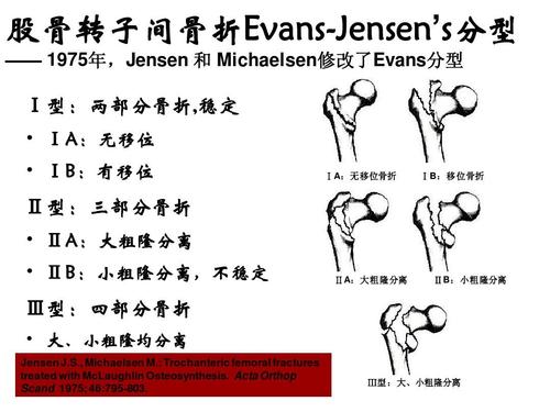 股骨转子间骨折严重吗 鄂州市罗倩春：关于股骨的优选文章