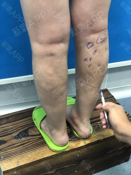 抽脂后皮肤松弛怎么恢复正常 宁德市宗亚枫：关于吸脂的知识普及