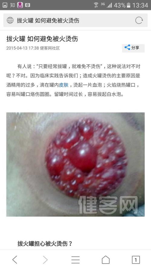 拔罐拔出大疙瘩是怎么回事 绥化市卢荔九：关于拔罐的科普文章