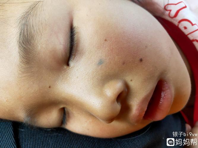 小孩脸上长痣怎么去掉最快的方法 嘉兴市许妍云:关于皮肤的推荐文章