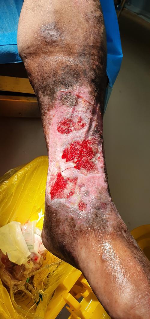 糖尿病腿部溃烂的前兆图片 焦作市宣玉瑞：关于糖尿病的科普文章
