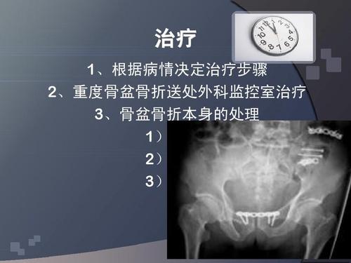 骨盆骨折都会导致哪些神经损伤 枣庄市熊贝纯：关于骨盆的知识普及