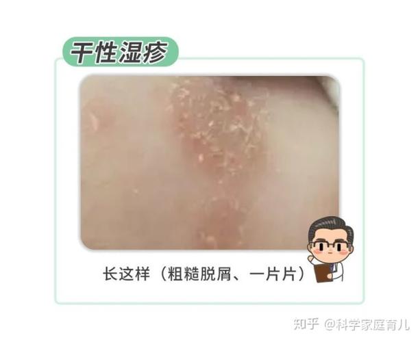 1岁宝宝干性湿疹的原因 武汉市杜秋妹：关于干性的知识普及