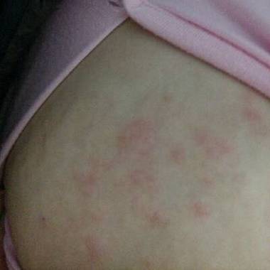 哺乳期乳房起湿疹,还可以喂母乳吗 济南市翁贞寒：关于湿疹的推荐文章