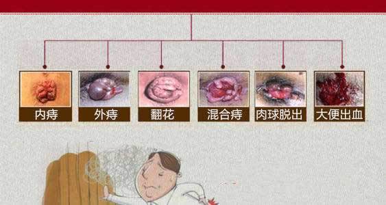 外痔痔核怎么能消除 阜新市邹勤芸：关于外痔的优选文章