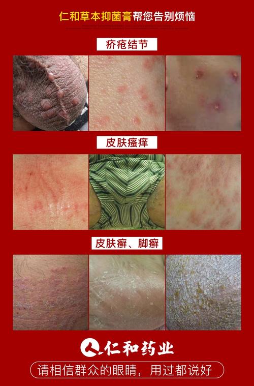 宝宝阴囊湿疹用什么药膏最好 漯河市项竹电：关于阴囊的推荐文章