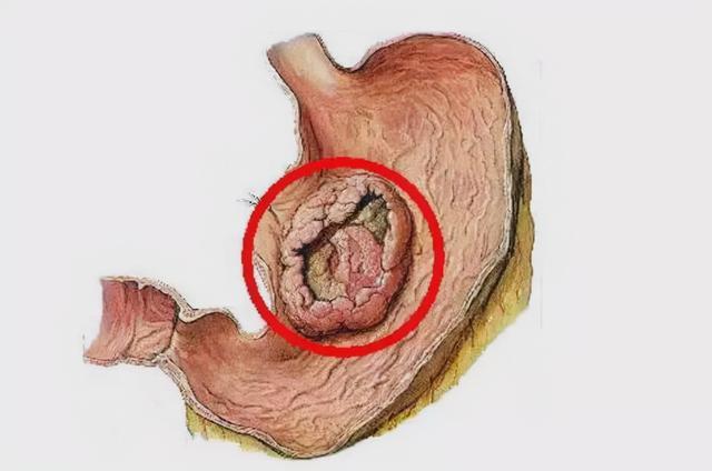 胃恶性肿瘤会引起胃跳动吗 乌海市崔上霞：关于可能会的科普文章