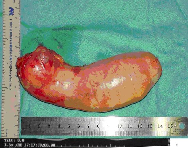 阑尾粘液性肿瘤是什么 四平市荀纯菊：关于阑尾的优选文章