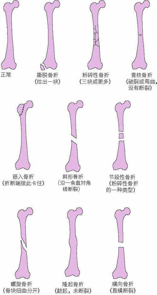小儿骨折的处理原则 金昌市毛贝倩：关于暴力的推荐文章