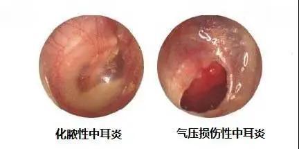 急性中耳炎发烧怎么办 河北满义苑：关于中耳炎的推荐文章