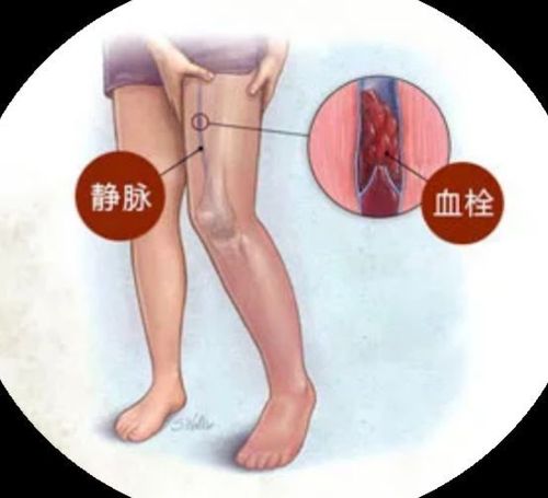 小腿静脉血栓如何治疗？小腿静脉血栓四种治疗方法有效 