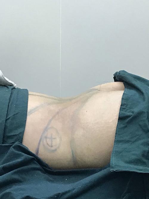 腰部抽脂后多长时间恢复 福建祝玉瑞：关于腰部的专家文章