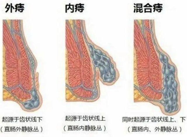 外痔有哪几种类型 沈阳市麻桂晓:关于外痔的知识普及