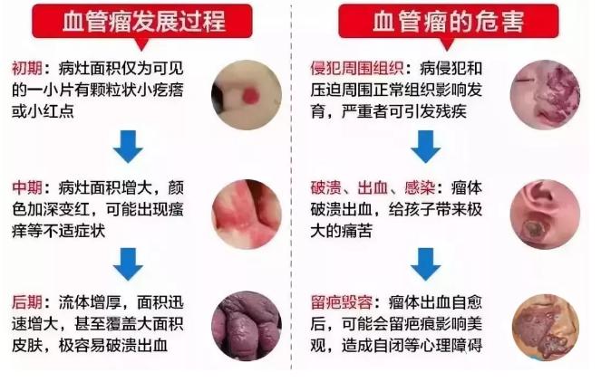 血管瘤的最佳治疗方法有哪些 六安市向青翠：关于血管瘤的专家推荐