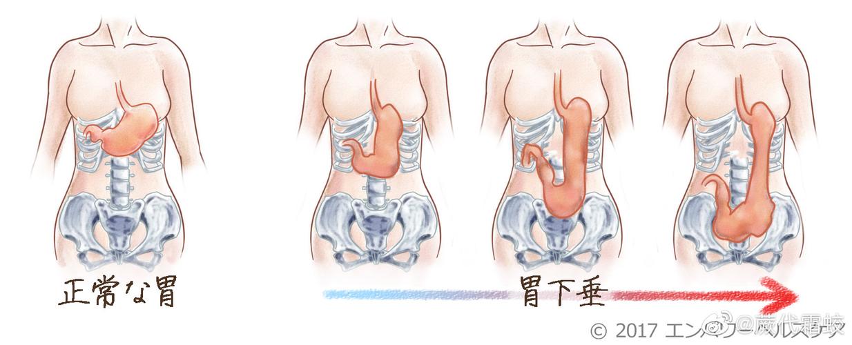 胃下垂有哪些症状表现 衡水市姚茗聪:关于症状的优选文章