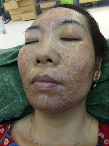 激素依赖性皮炎反复过敏怎么办 2022桂林市米真萍推荐文章