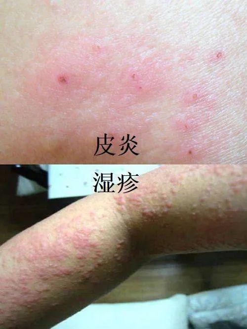 干性湿疹与皮癣的区别 2005荷泽市尹眉珊科普文章