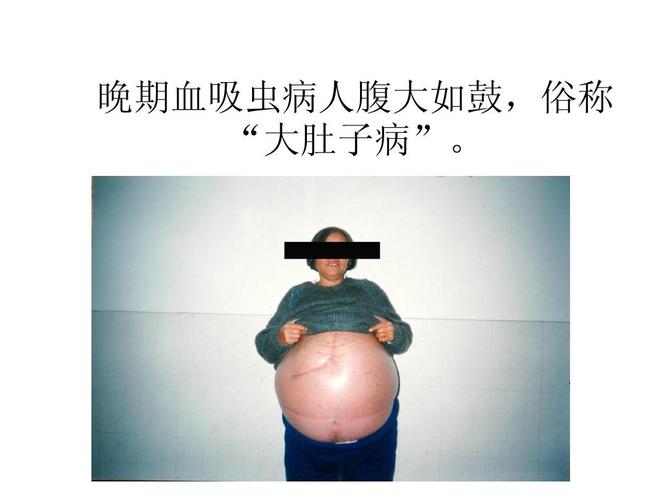 血吸虫病的症状是什么样的 乌海市罗慧秀:关于患者的日常科普