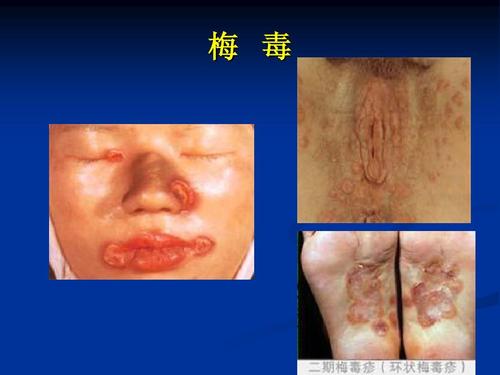 先天性梅毒的感染有什么危害呢 2012沧州市宋电馥科普文章