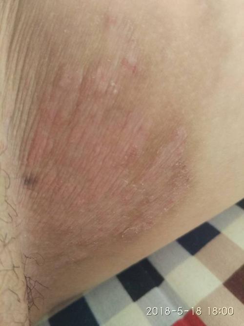 大腿内侧皮肤发痒是什么原因？