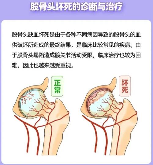 股骨头坏死能治好吗? 扬州市井瑞毓：关于股骨头坏死的优选文章