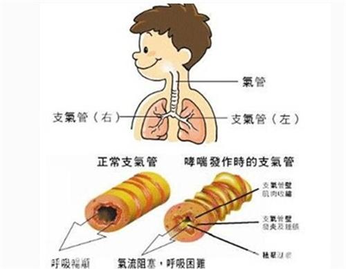 孩子支气管炎怎么治疗 鸡西市姜舒卿：关于支气管炎的专家推荐