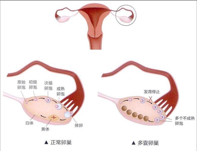 多囊卵巢闭经中药配方 2008三门峡市卞翠凡专家文章