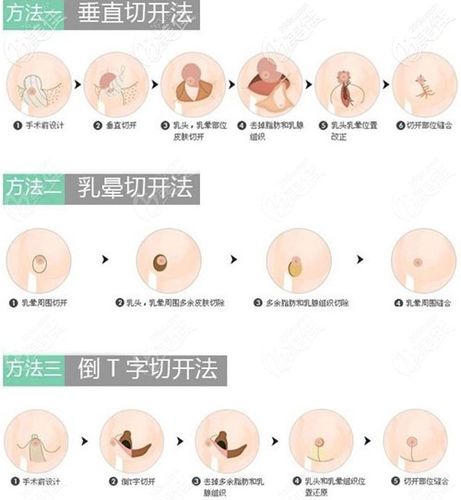 产后多久可以做缩胸手术 北海市华贞马：关于乳房的科学普及
