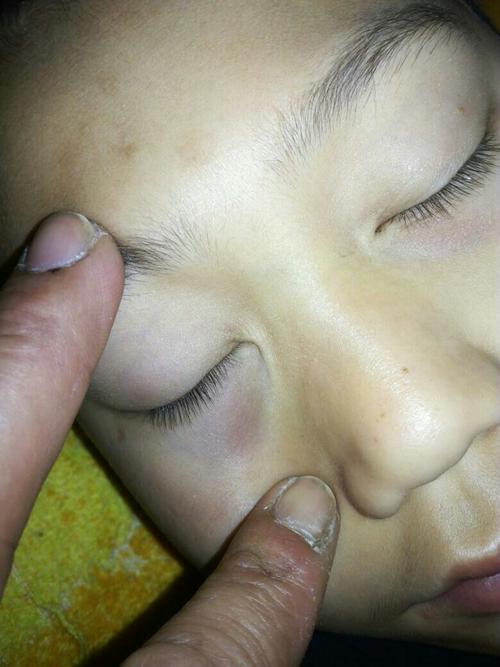 眼圈发青如何快速消除 2005渭南市诸玲可科学普及