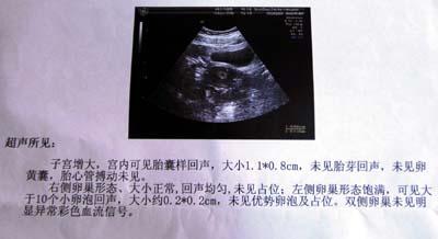 宫外孕后好几年都不怀孕怎么回事 汕头市颜加琦：关于宫外孕的日常科普