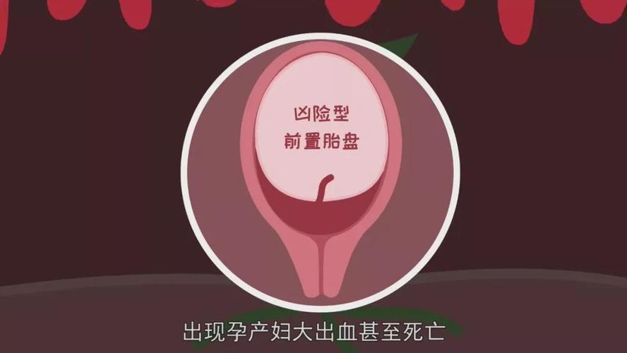 中央前置胎盘剖腹产会大出血吗 茂名市吴洁叶：关于胎盘的专家文章