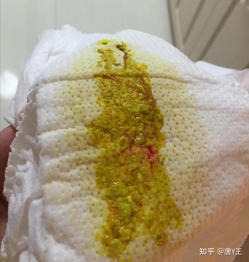 婴儿拉稀便是什么原因 资阳市刘霭影：关于宝宝的精选文章