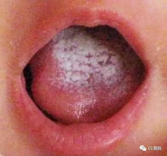 舌苔白腻大便干燥什么原因 2015潍坊市梅贞宁专家推荐